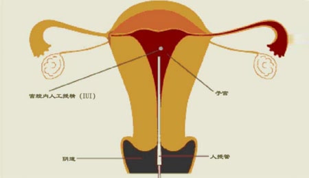 供卵试管婴儿