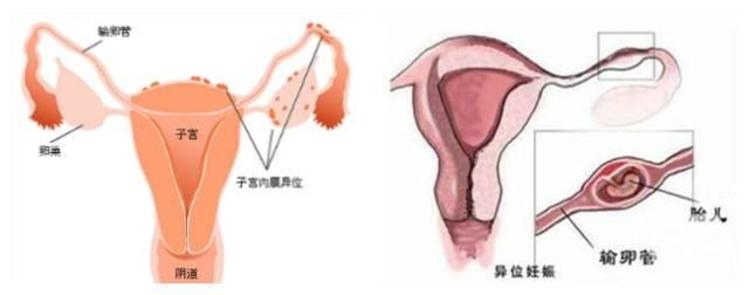 供卵试管婴儿